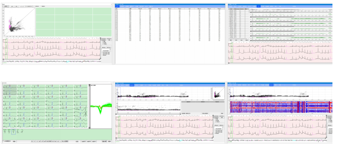 Intelligent arrhythmia analysis