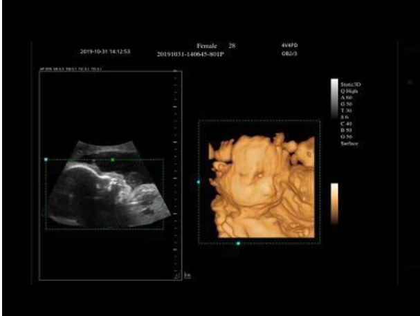 3D / 4D Fetal
