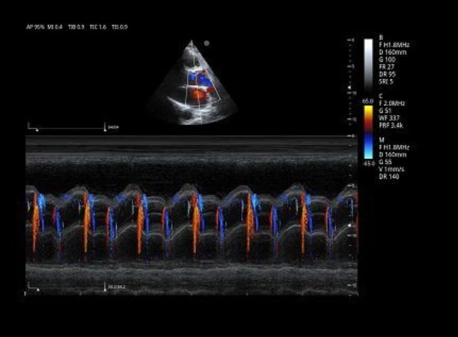 Cardiac PW Doppler