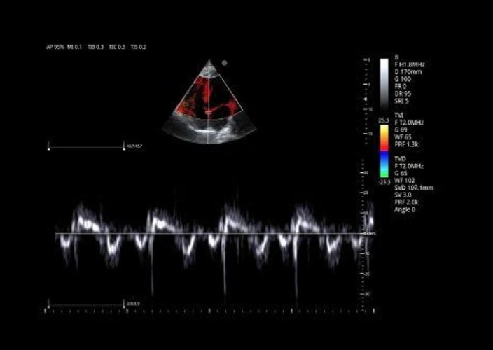 Cardiac TDI
