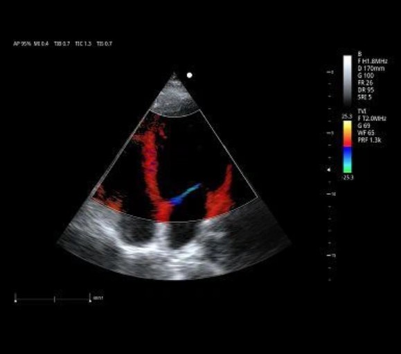 Color Doppler