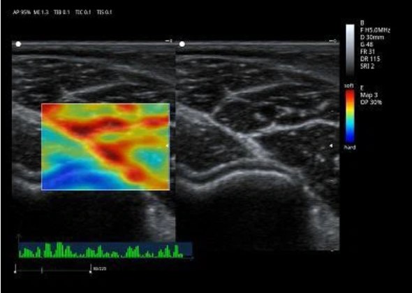 Strain Elastography Elastography