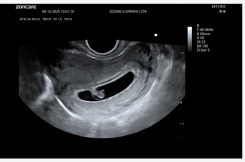 Early Pregnancy
