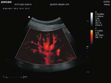 AMM cardiac analysis