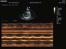 Auto OB measurement
