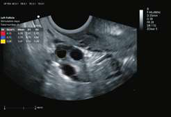 Auto Follicle
