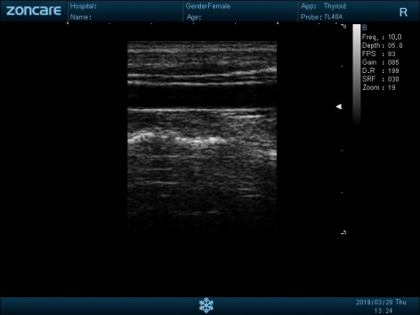 CCA · PW Doppler scan sample