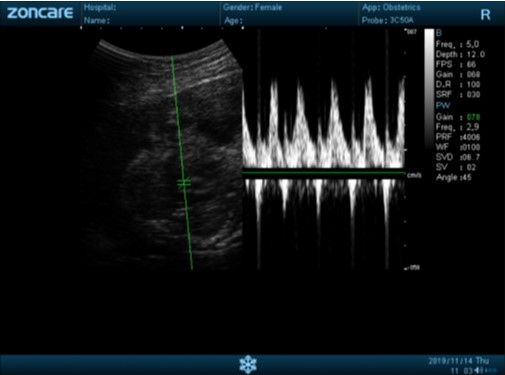 Portal vein PW scan sample