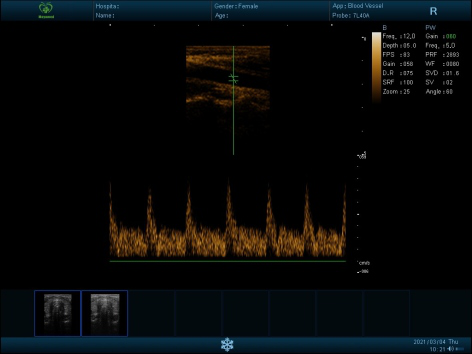 Liver-Kidney B-mode scan sample